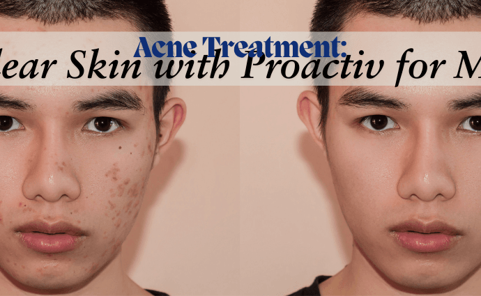 Acne Treatment