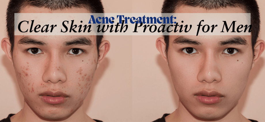Acne Treatment
